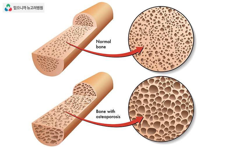 골다공증
