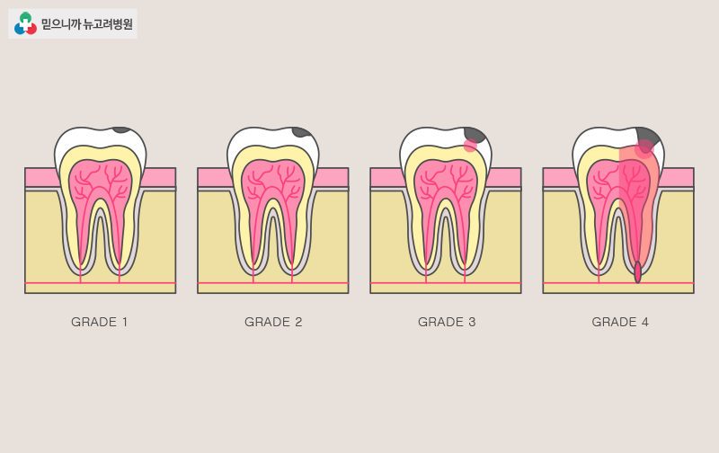 충치(치아 우식증)