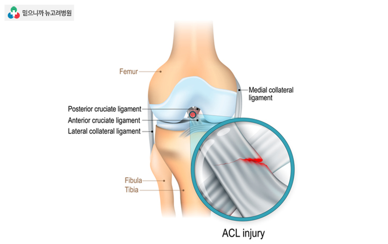 무릎 십자인대파열