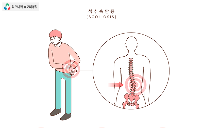 척추 측만증