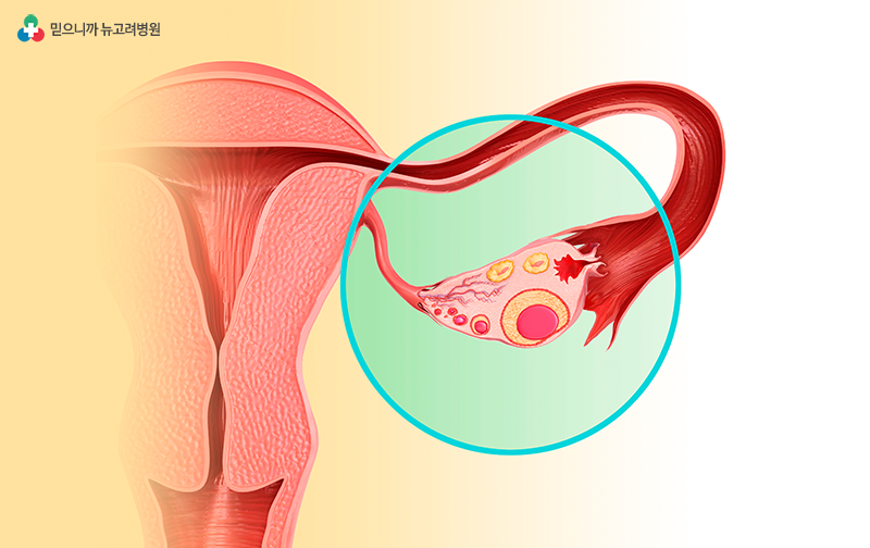 난소낭종